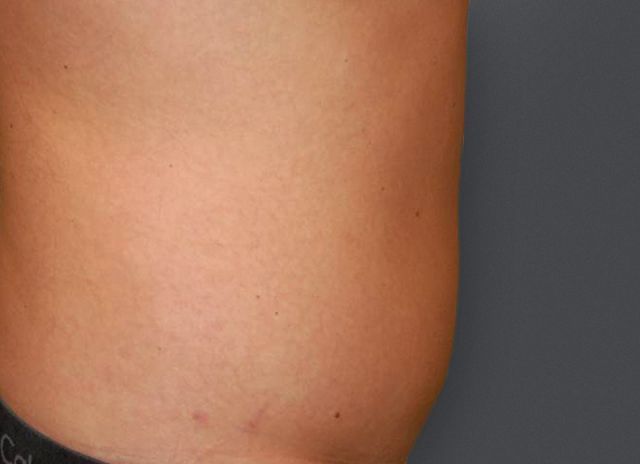 Avant Abdominoplastie 