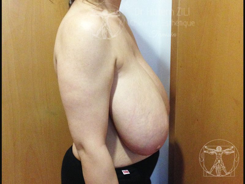 R&eacute;duction mammaire - Avant 