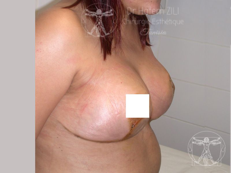 R&eacute;duction mammaire - Apr&egrave;s