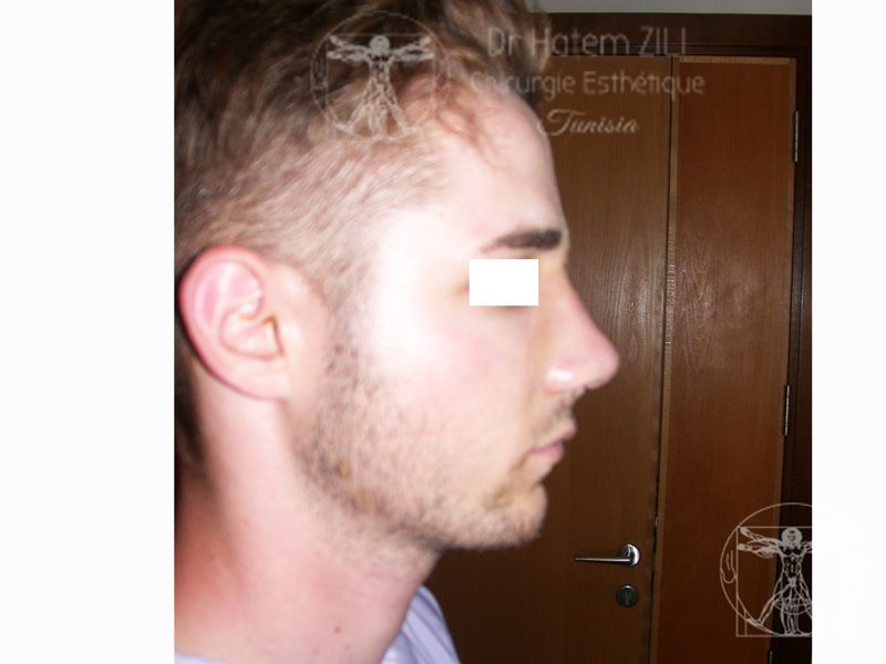 Rhinoplastie Après
