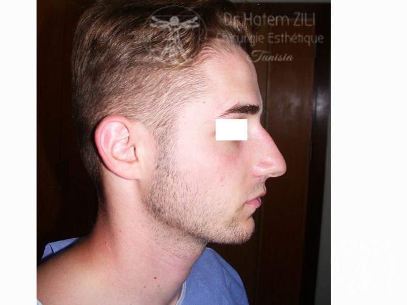 Rhinoplastie Avant intervention