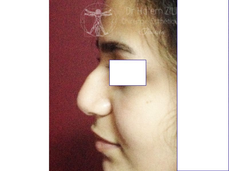 Rhinoplastie Avant intervention