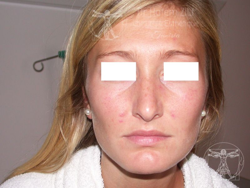 Rhinoplastie Avant intervention