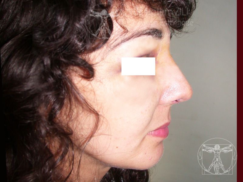 Rhinoplastie Après