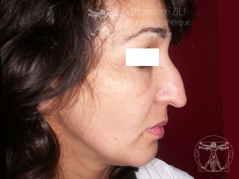 Rhinoplastie Avant intervention