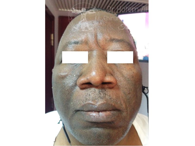 Rhinoplastie Avant intervention