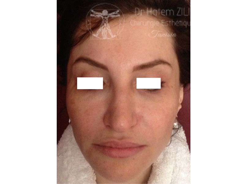 Rhinoplastie Avant intervention