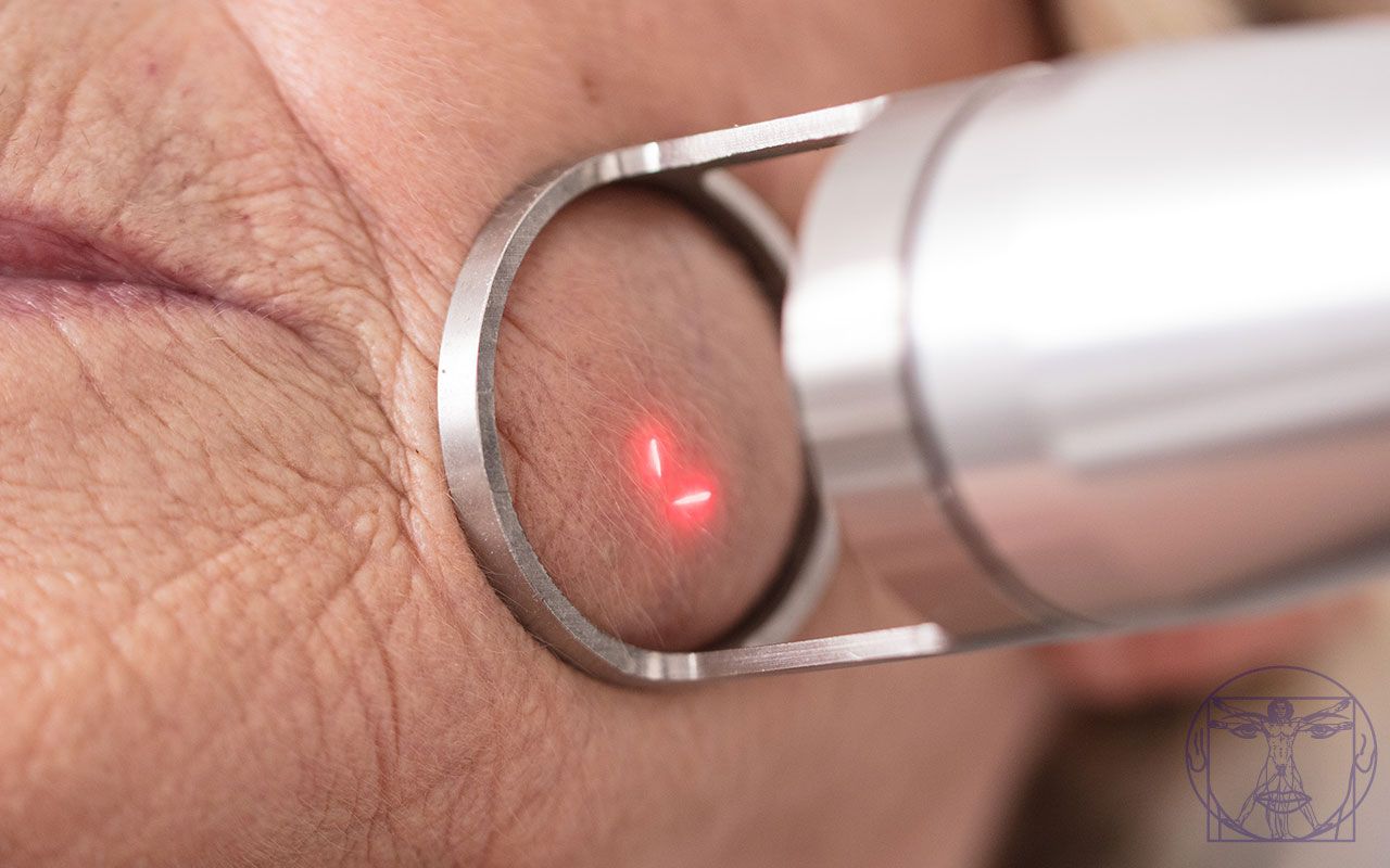 laser CO2 fractionn&eacute; - traitement des rides