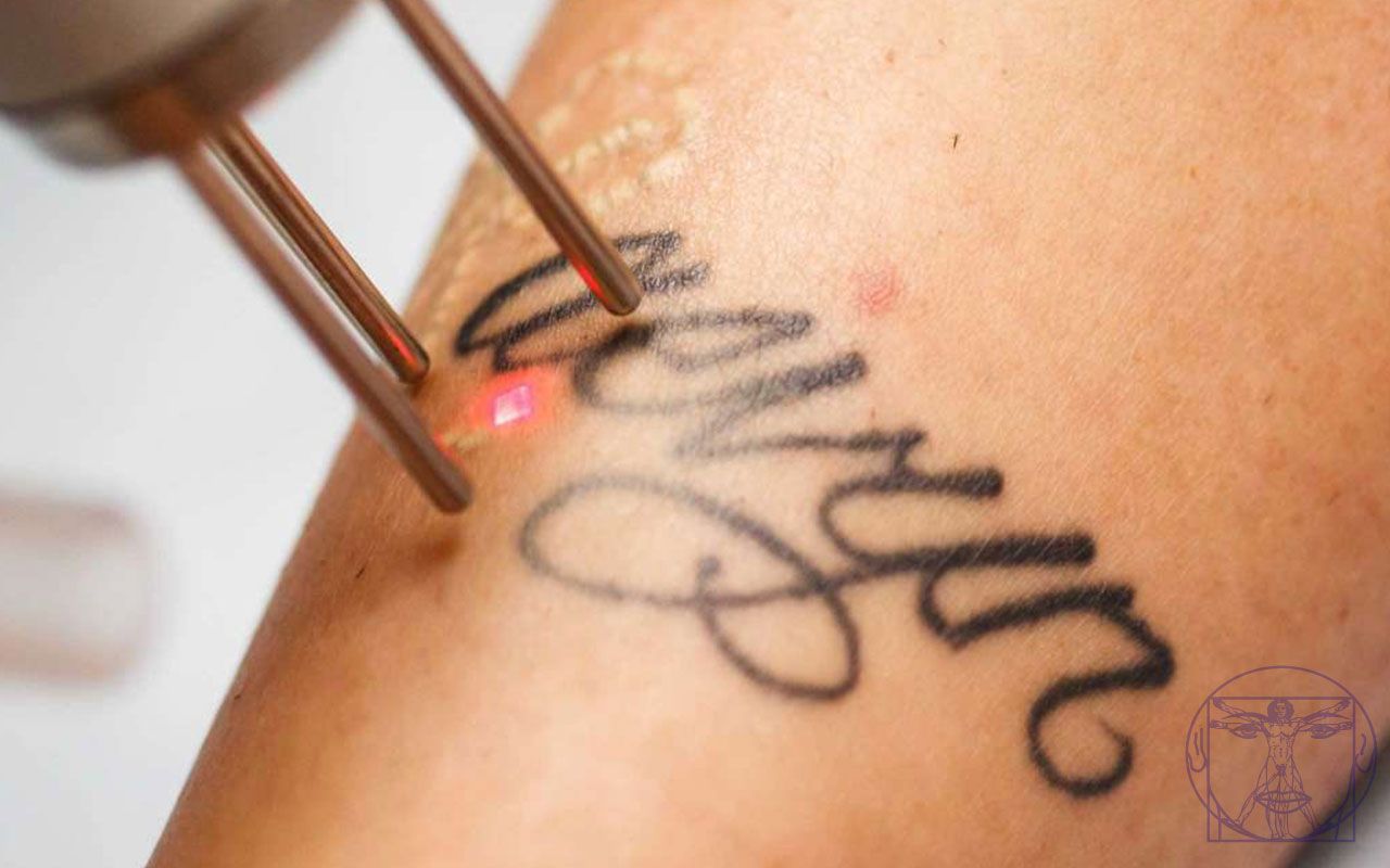 D&eacute;tatouage au laser 