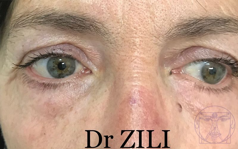 Bl&eacute;pharoplastie Apr&egrave;s