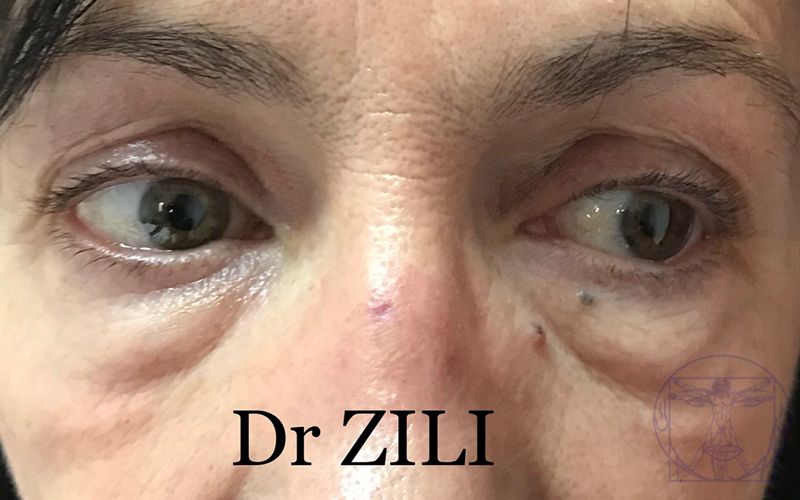 Bl&eacute;pharoplastie Avant